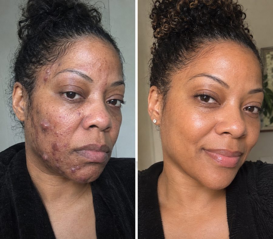 Rachel S. before and after results
